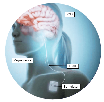 Illustration of a traditional setup for vagus nerve stimulation consisting of a stimulator that passes electric stimulation through the leads and cuffs to the attached vagus nerve.
