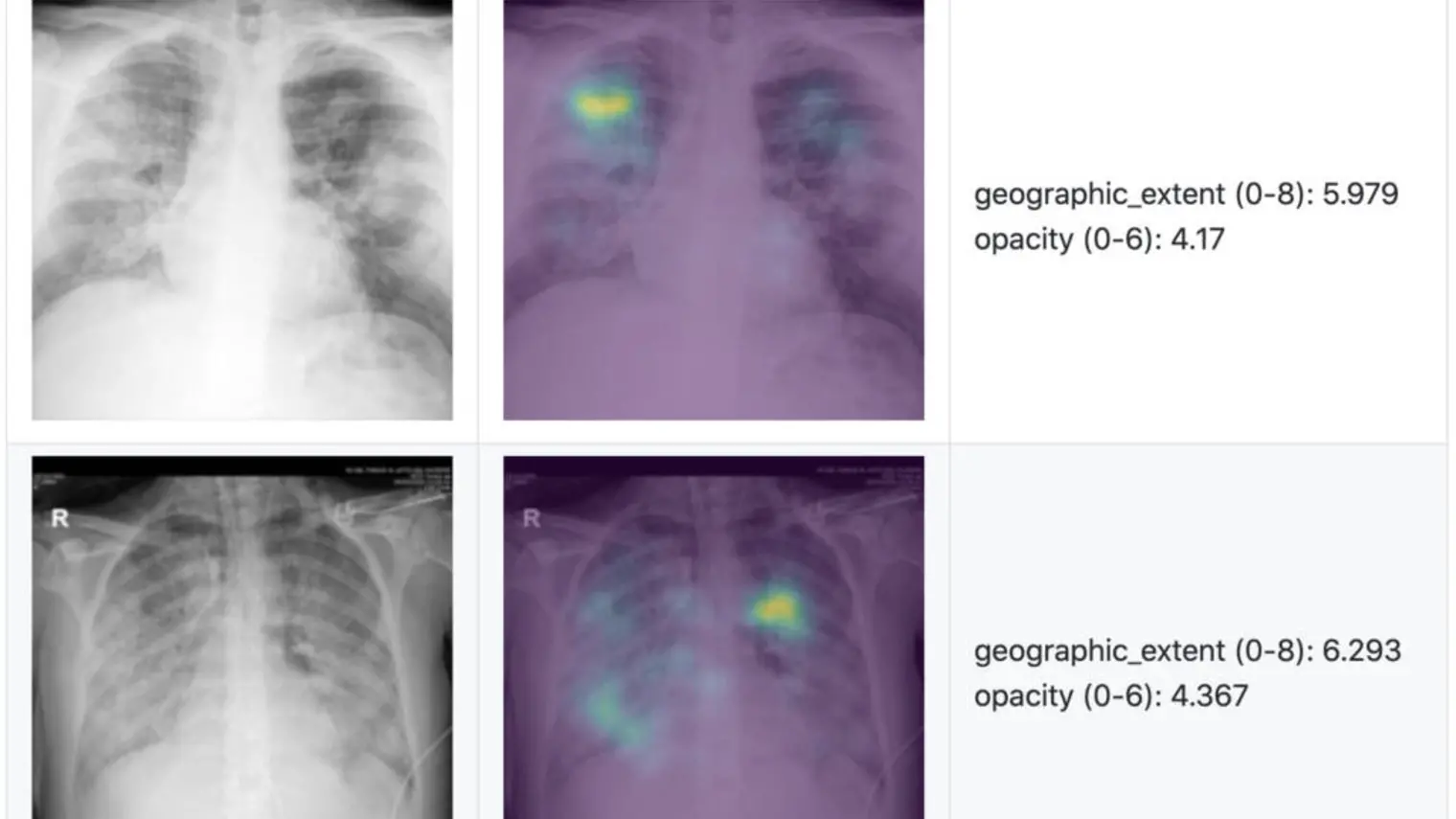 A collaboration with Stony Brook Medicine to Build a COVID-19 Severity Prediction Tool