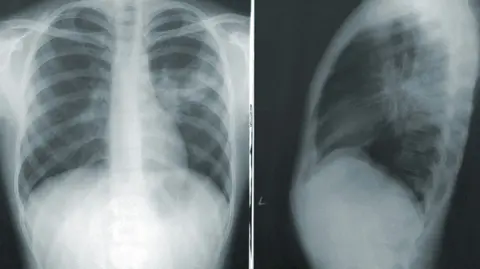 A frontal and lateral chest X-ray showing the lungs and ribcage.