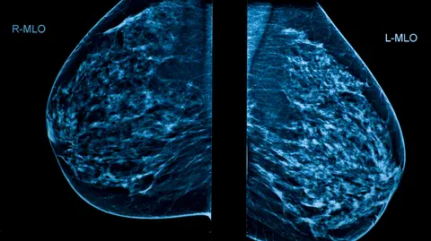 Mammogram image showing the left and right breasts. 
