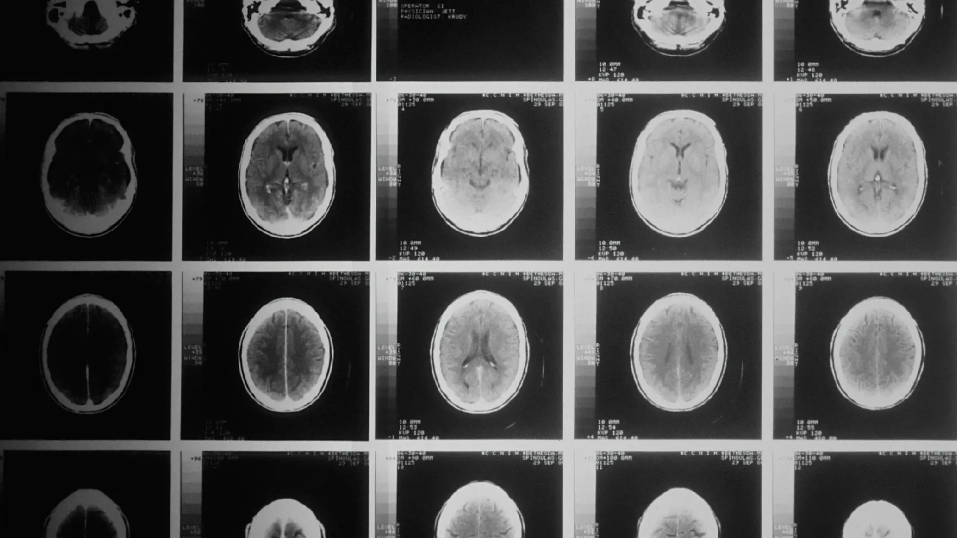 A head x-ray taken by a computer-assisted tomographic (CAT) scanner.