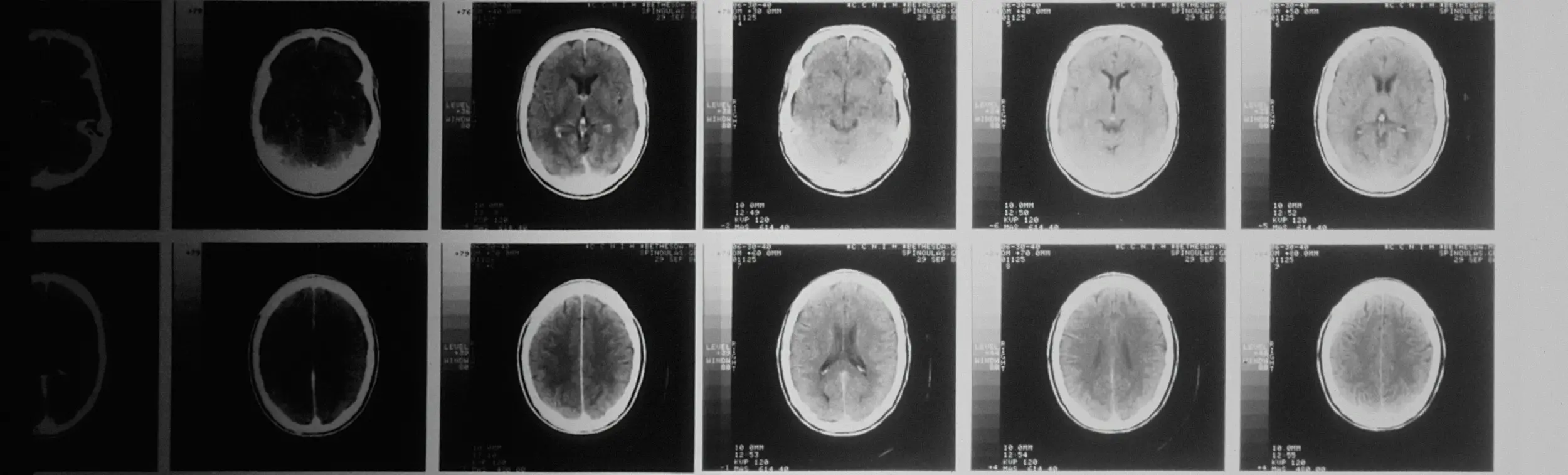 Une radiographie de la tête prise par un scanner assisté par ordinateur.