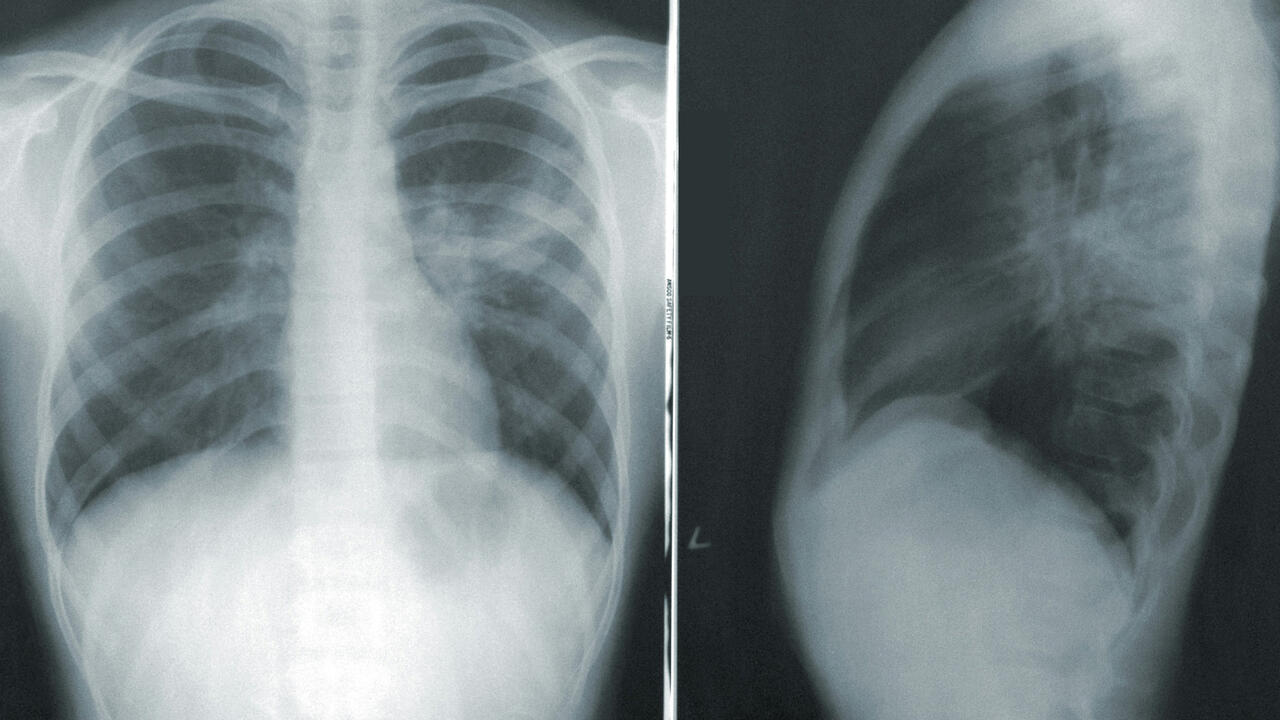 A frontal and lateral chest X-ray showing the lungs and ribcage.